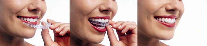 Invisalign Trio